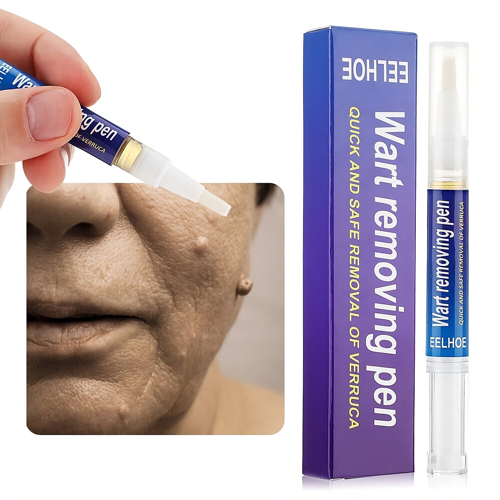Skin Wart Removing Pen - Miraaj