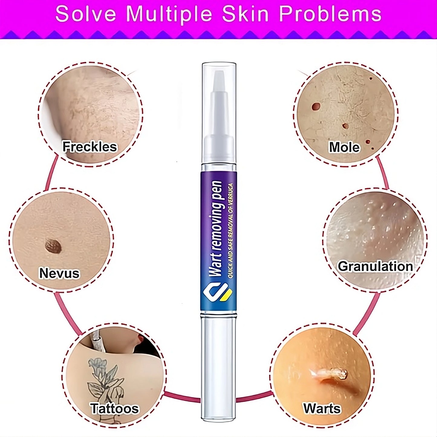 Skin Wart Removing Pen - Miraaj