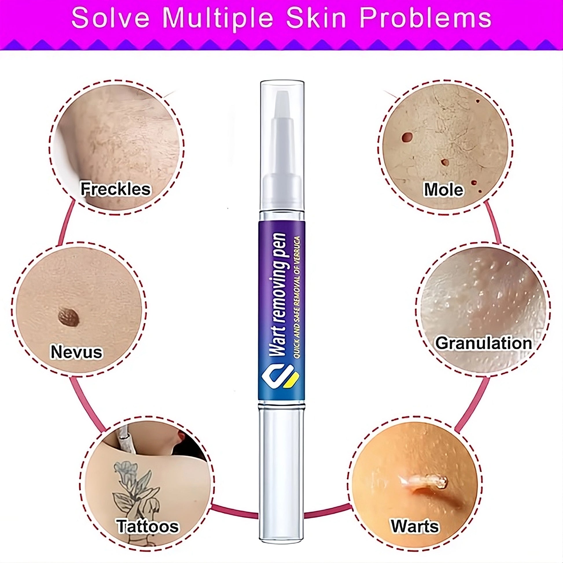 Skin Wart Removing Pen - Miraaj