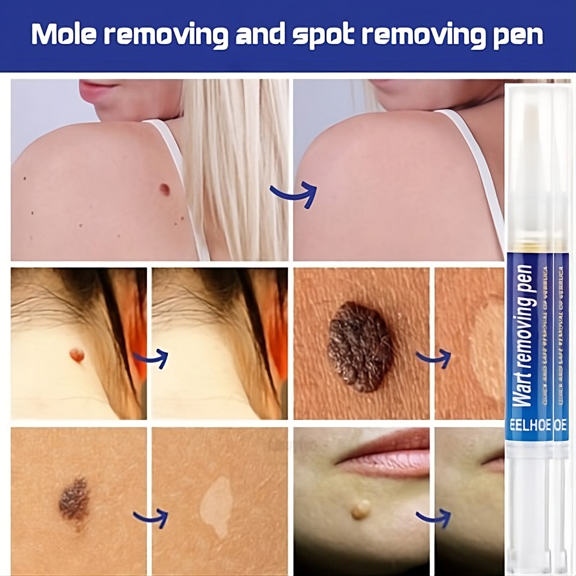 Skin Wart Removing Pen - Miraaj